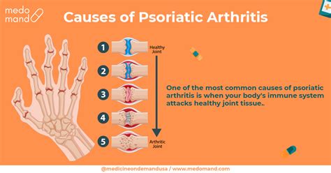 What is Psoriatic Arthritis? Its Causes, Symptoms, & Treatment