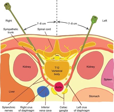 anatomy of percutaneous retrocrural neurolytic celiac plexus block. | Download Scientific Diagram