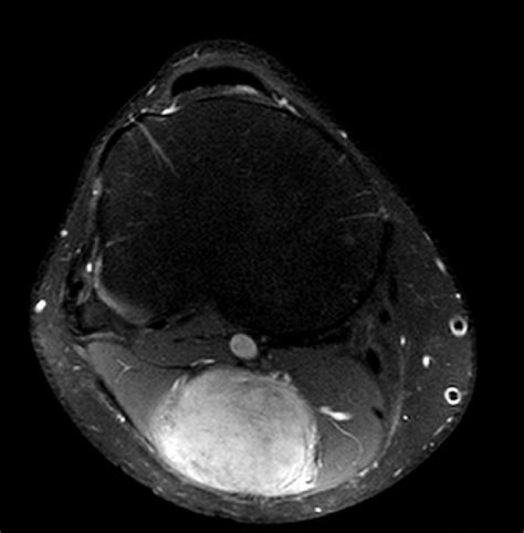 Right thigh MRI showed a 6×4×3 cm well-defined capsulated heterogeneous... | Download Scientific ...