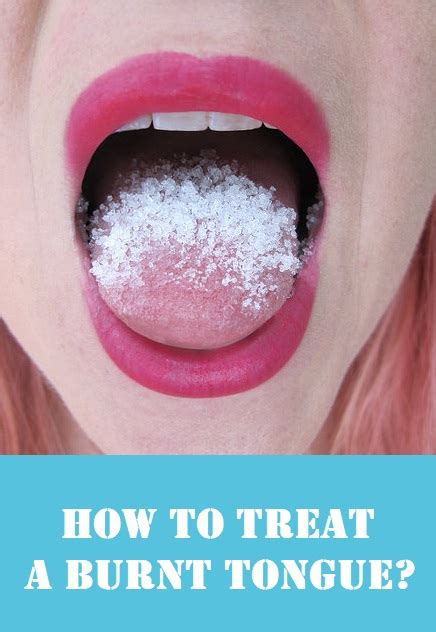 7 Best Home Remedies for Burnt Tongue with Your Kitchen Ingredients