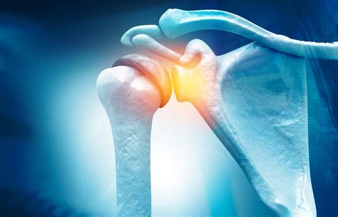 Frozen Shoulder: Symptoms, Causes, And Treatment - Stylista Fitness