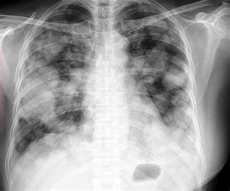 Metastatic Breast Cancer Treatment & Pharmacologic Management