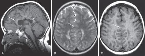 Prosencephalic Development | Neupsy Key