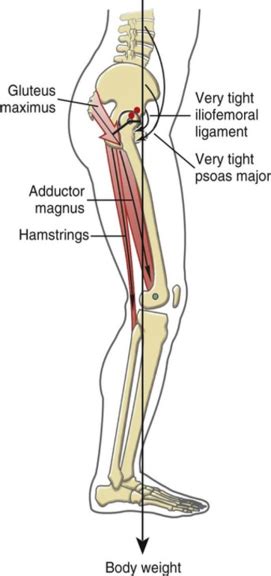 Principles of Biomechanics in Hip Flexion Contracture - Physiopedia