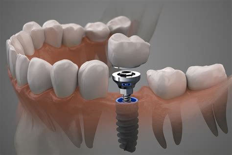 A Brief Look at the Dental Implant Procedure | Santa Rosa, CA