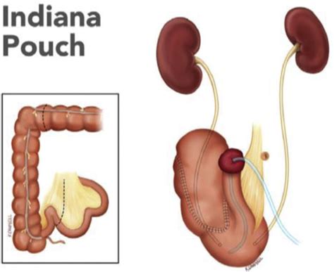 Urinary Diversion: Core Curriculum 2021 - American Journal of Kidney Diseases