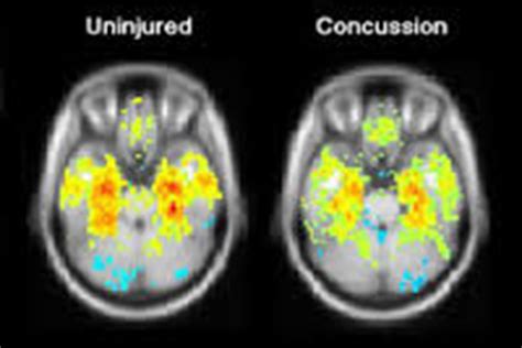 How is a concussion diagnosed? - Godoy Medical Forensics