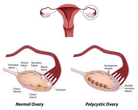 Controlling PCOS, Polycystic Ovarian Syndrome - AIM Women’s Wellness Center