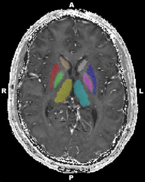 Iron Concentration in Deep Gray Matter Structures is Associated with ...