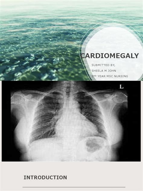 An Overview of Cardiomegaly: Causes, Symptoms, Diagnosis and Treatment of an Enlarged Heart ...