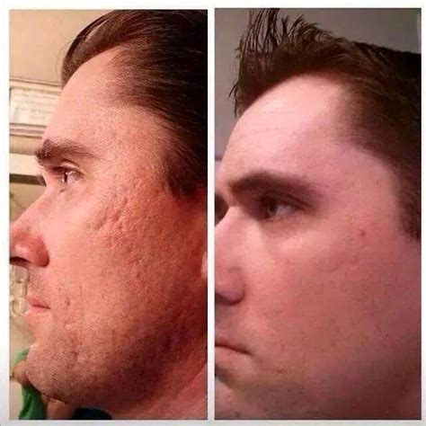 Nerium AD WILL CLEAR OUT THOSE DISTURBING CRATERS #FeelGood | Acne treatment overnight, Acne ...