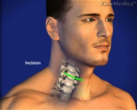 Cervical Corpectomy - Birmingham, AL - Spine and Neurosurgery