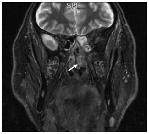 Extramedullary nasal plasmacytoma arising after polyp excision and the role of the inflammation ...