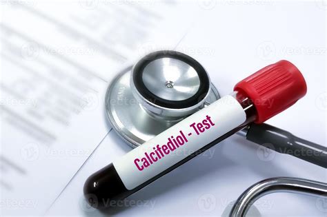 Blood sample for 25 hydroxyvitamin D3 test, also known as calcifediol, calcidiol, 25 ...