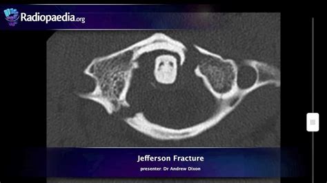 Jefferson Fracture Xray