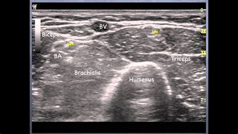 Ulnar Nerve Ultrasound