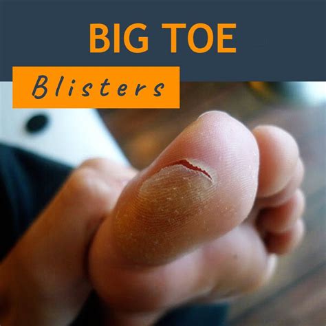 Big Toe Blisters: Types, Causes & Prevention - Blister Prevention