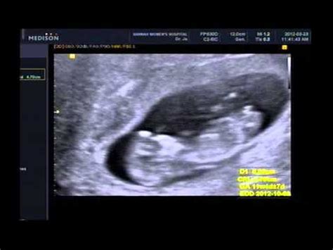 ultrasound pregnancy 3 months baby Ahjin - YouTube