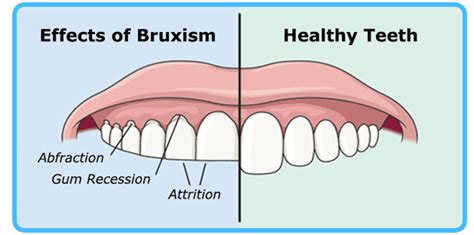 Tooth grinding or Bruxism, what is it? – Dentist Downers Grove ...