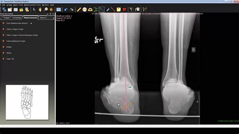 X Ray Hindfoot Fusion