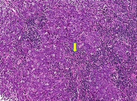 Nasopharyngeal Carcinoma Histology