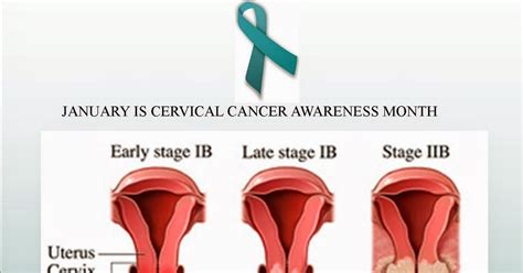 my life after cervical cancer: What a Stage B Cervical Cancer Looks Like