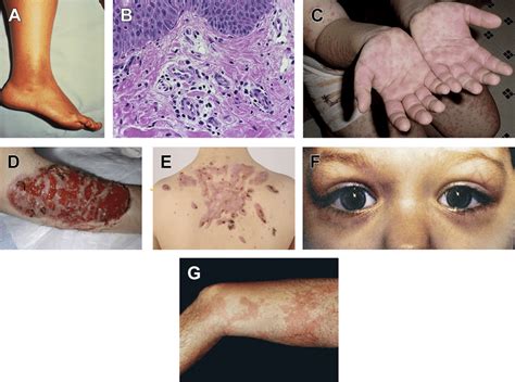 (A) FMF: well-demarcated, swollen, bright erythematous erysipelaslike... | Download Scientific ...