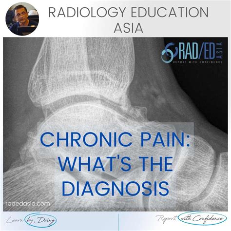 ANKLE IMPINGEMENT RADIOLOGY ANTERIOR X-RAY (VIDEO) - Radedasia