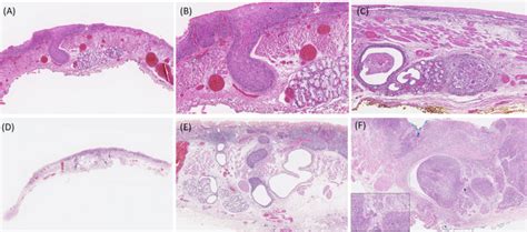 Risk factors and pathological characteristics for intraductal tumor spread of submucosal gland ...