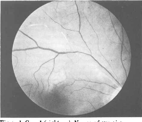 Figure 1 from Microangiopathy of the brain and retina | Semantic Scholar