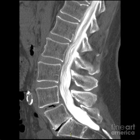 Disc Herniation, Ct Myelogram Photograph by Living Art Enterprises - Pixels