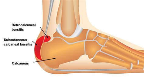 Achilles Bursitis | Retrocalcaneal Bursitis - Symptoms, Causes & Treatment