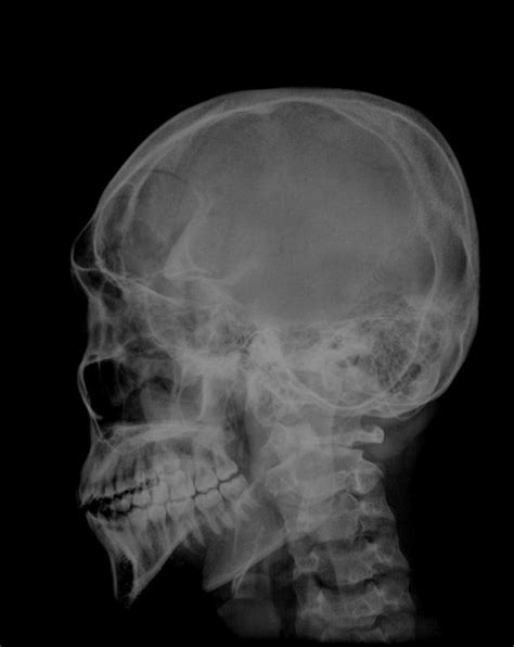 A schedel AP radiograph of the skull - Black Background - Free Stock ...