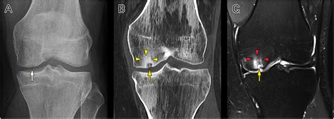 Subchondral Cyst