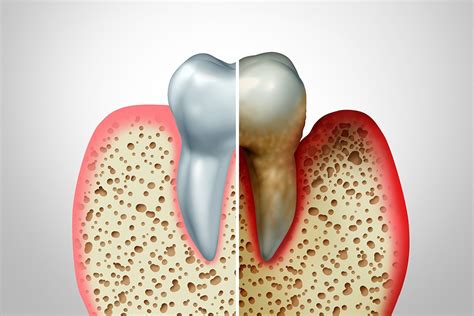 Visual Aids Showing Severe Periodontitis Shown to Motivate Periodontally-involved Patients ...