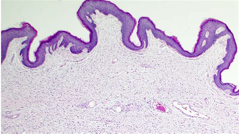 Fibroepithelial Polyp Histology