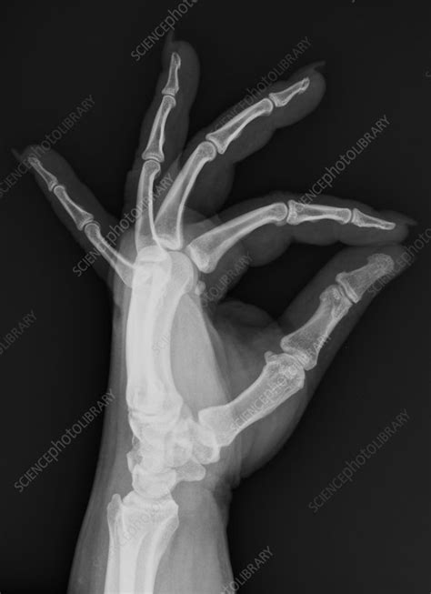 Normal hand, X-ray - Stock Image - C039/3289 - Science Photo Library