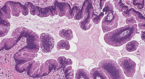 Intraductal papillary mucinous neoplasm of the pancreas | Ottawa Atlas of Pathology
