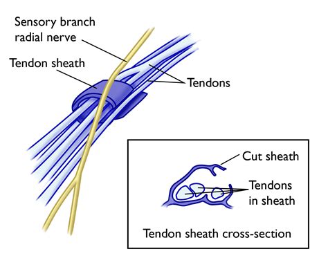 De Quervain's Tenosynovitis Symptoms and Treatment - OrthoInfo - AAOS