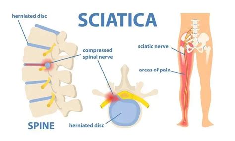 How Long Does Sciatica Last? Best 3 Ways To Deal With It! | SLECK