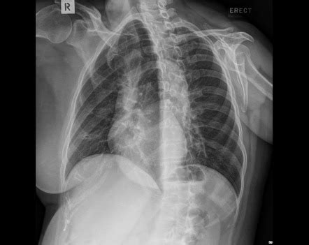 Ribs (AP oblique view) | Radiology Reference Article | Radiopaedia.org