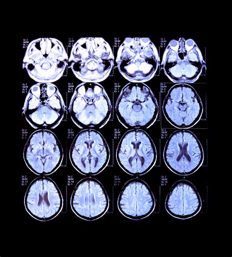 Neuroimaging: What is it and how can it map the brain?