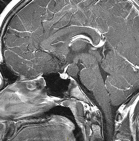 Hypothalamic Hamartoma, MRI - Stock Image - C030/6381 - Science Photo ...