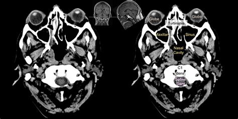 Ct Brain Anatomy - Anatomy Reading Source