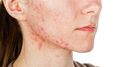 What Is Fungal Acne? Causes, Treatments, and Symptoms | Allure