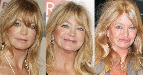 Goldie Hawn Plastic Surgery Before and After Pictures 2024