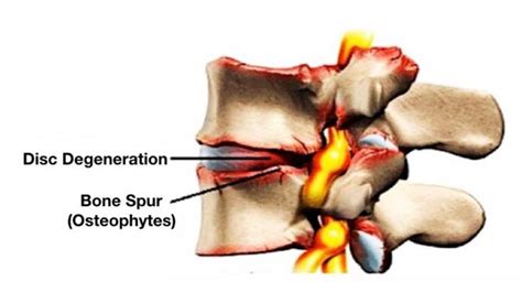 Wear and tear of lumbar spine joints - An Tâm