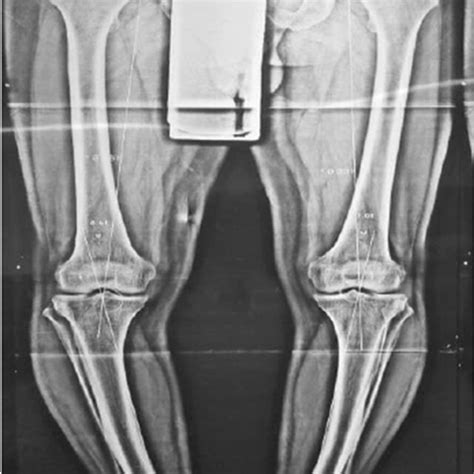 Preoperative anteroposterior radiography showing the severe varus ...