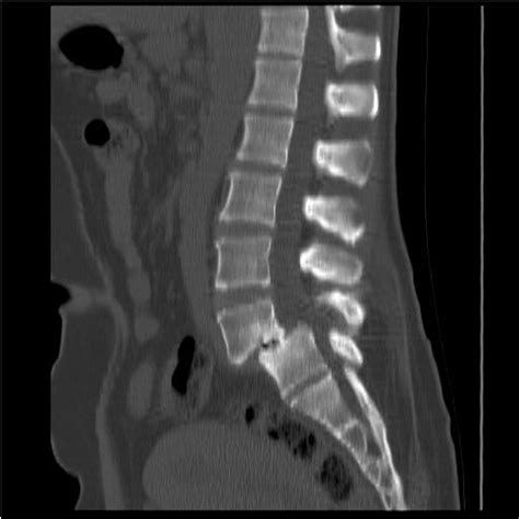 Spondylolisthesis L4-L5 grade II | Image | Radiopaedia.org