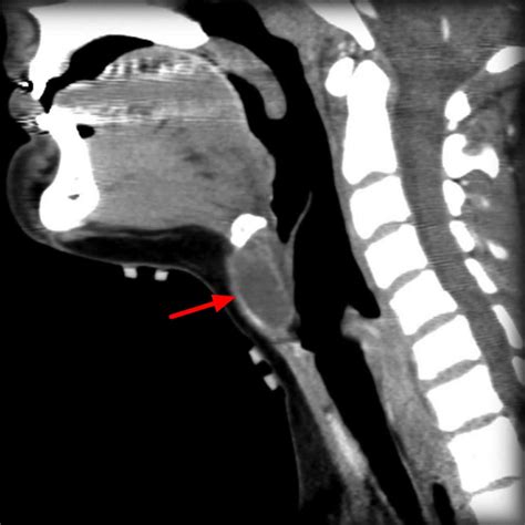 Thyroglossal duct cyst causes, symptoms, diagnosis, treatment & surgery